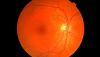 ¿Qué debo saber sobre mi retinopatía diabética?